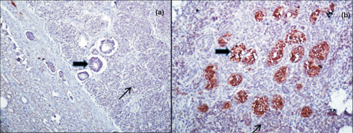 WT1 expression in first group of Wilms’ tumours. (a) and (b) nuclear-cytoplasmic WT1 immunostaining in epithelial component (tubules) shown by thick arrows. (a), (b) Diffuse WT1 immunostaining in blastema, shown by thin arrows (Immunostain x200).